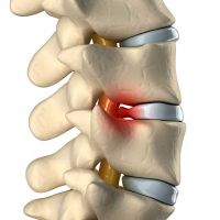 spine-discherniation-Causes